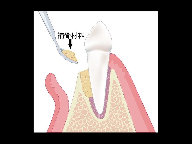 牙周再生手術-再生原理圖-補骨粉-葉立維醫師-桃園牙周病