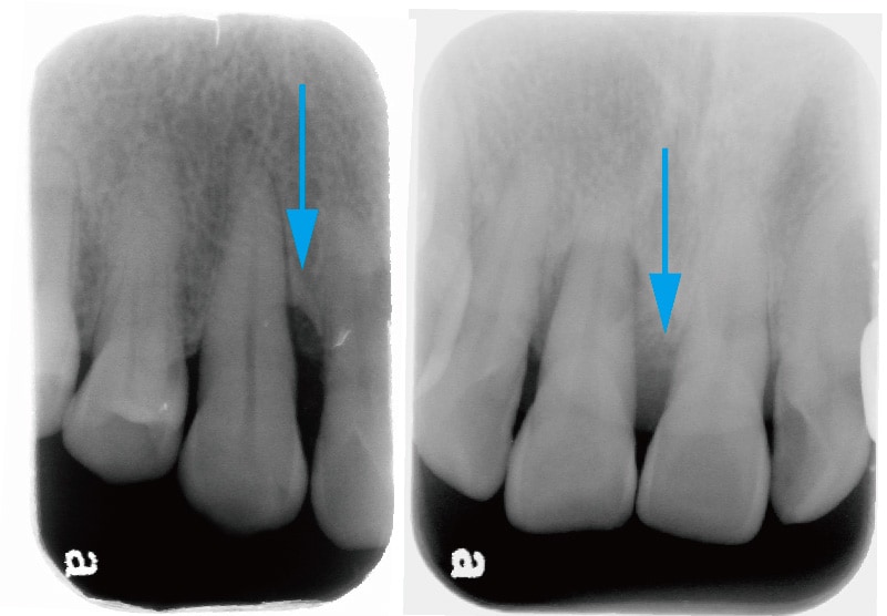 牙周再生手術-術前-X光片-骨頭缺損處