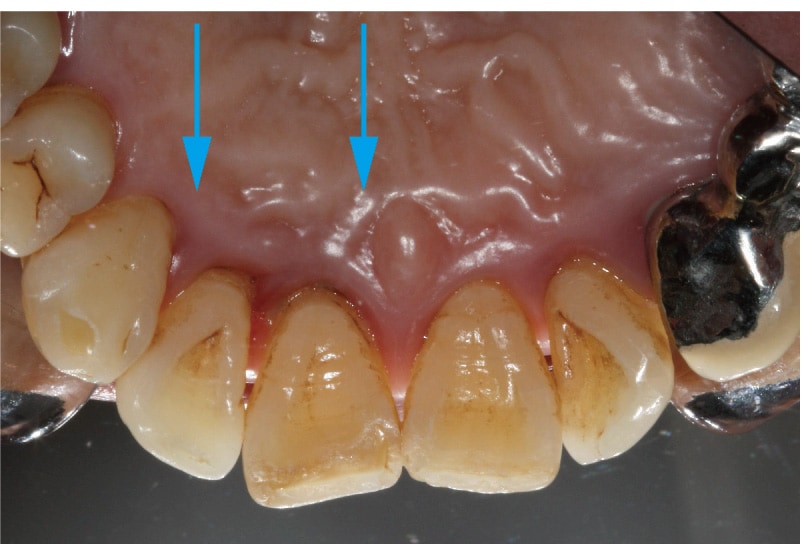 牙周再生手術-術前-牙齦發炎處