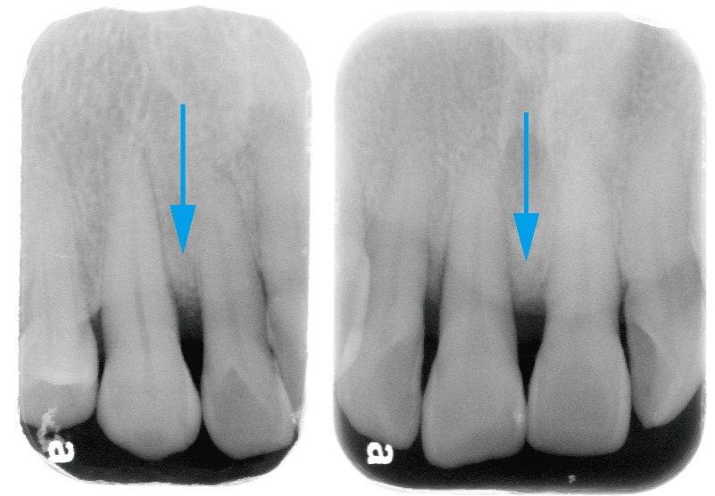 牙周再生手術-術後-X光片-骨頭再生處