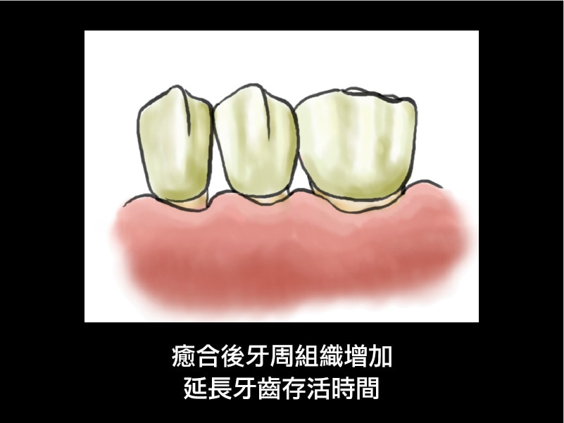 牙周再生手術-術後-延長牙齒壽命-牙周病手術-葉立維醫師-桃園牙周病