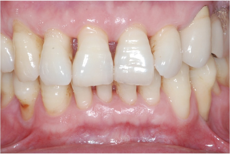 牙周再生手術-術後-牙周狀況穩定-牙齦不再浮腫