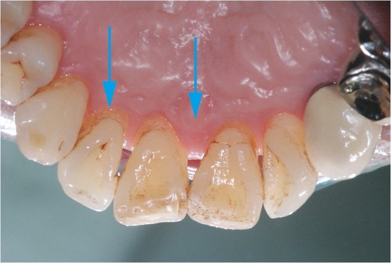 牙周再生手術-術後-牙周狀況穩定
