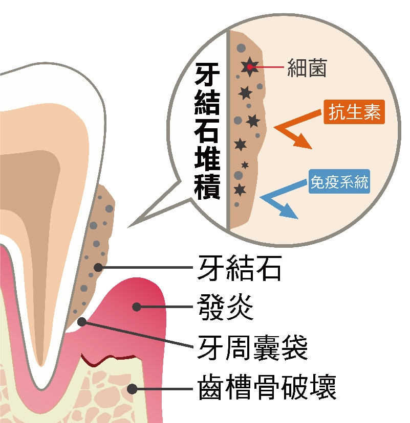 牙周囊袋-牙結石堆積-發炎-齒槽骨破壞-桃園牙周病-葉立維醫師