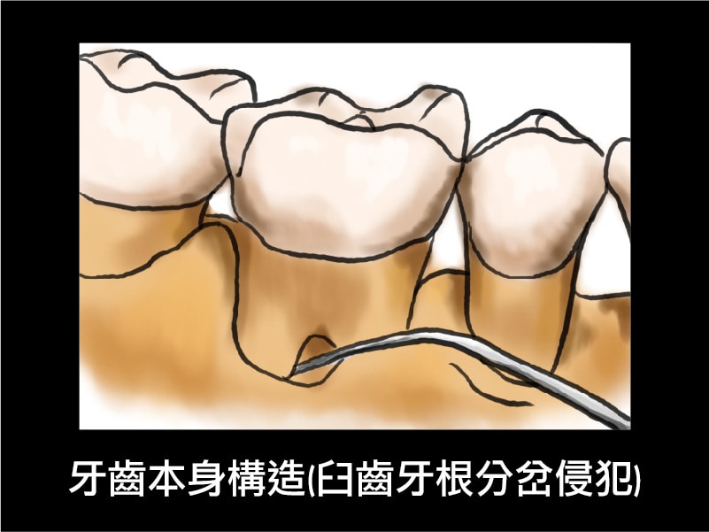 牙周囊袋-牙齒本身構造-臼齒牙根分岔侵犯-葉立維醫師-桃園牙周病