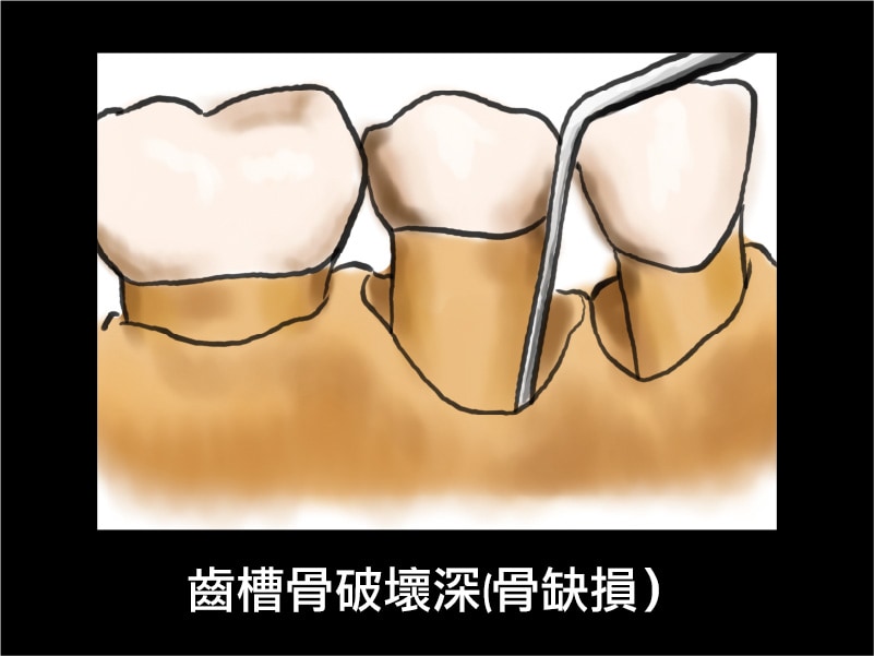 牙周囊袋-齒槽骨破壞深-骨缺損-葉立維醫師-桃園牙周病