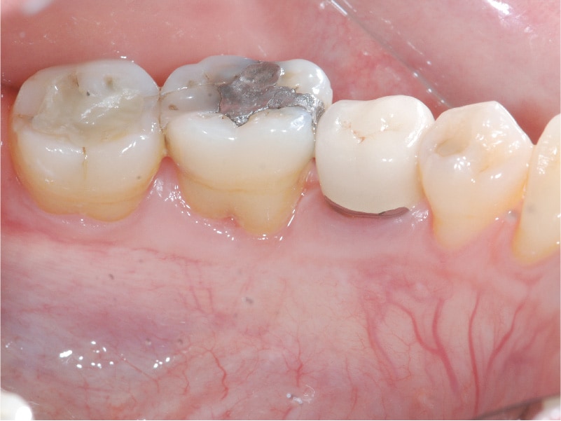 牙周囊袋手術-牙周病補骨-手術後-術後追蹤一年-牙周狀況