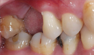 牙周病拔牙-缺牙-牙周翻瓣手術案例