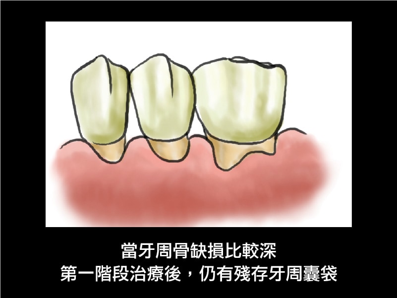 牙周病治療-牙周囊袋-牙周病手術-葉立維醫師-桃園牙周病