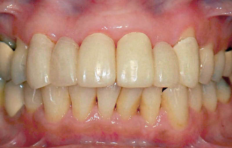 牙周病治療前-拆除門牙假牙-更換臨時假牙