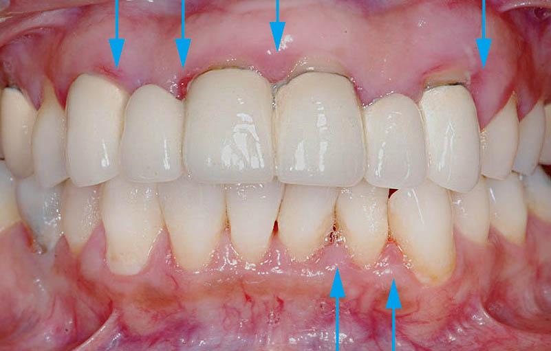 牙周病治療前-牙齦紅腫流血