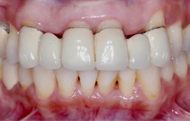 牙周病治療前-門牙舊假牙露出金屬黑邊