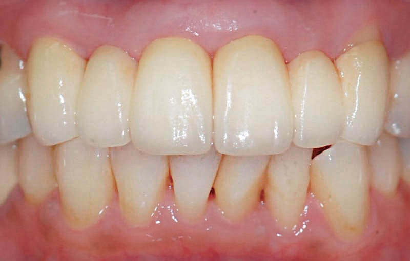 牙周病治療後-牙周再生手術-全瓷假牙