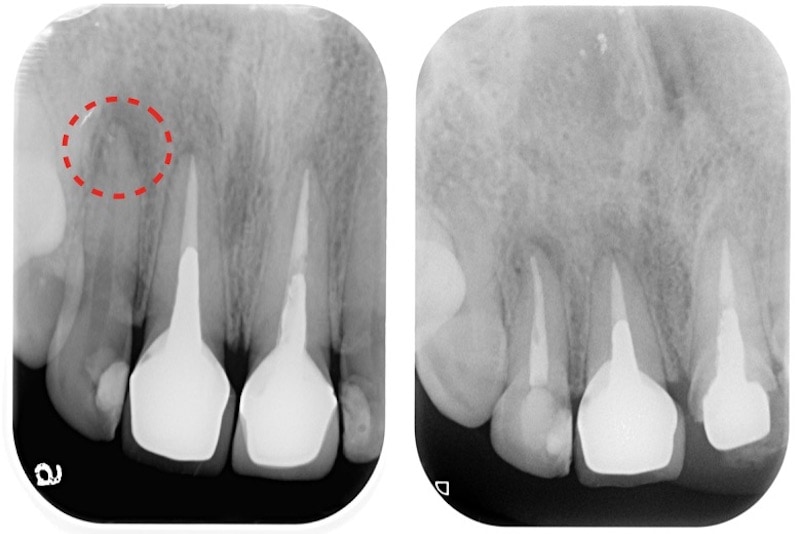 門牙-牙根發炎-根管治療-治療前後X光片
