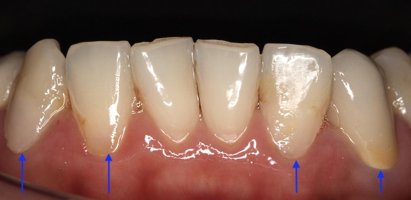 牙周病治療-2016年-樹脂補牙-傳統假牙-修復門牙蛀牙