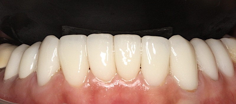 數位牙科-全瓷冠-陶瓷貼片-下顎10顆-門牙假牙-桃園牙周病