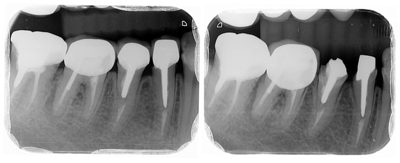 拆除舊假牙-臨時假牙-暫時修復右下小臼齒