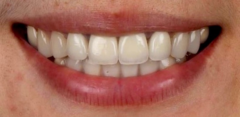 數位牙科-DSD數位微笑設計-可試戴方便溝通齒色-形態-排列