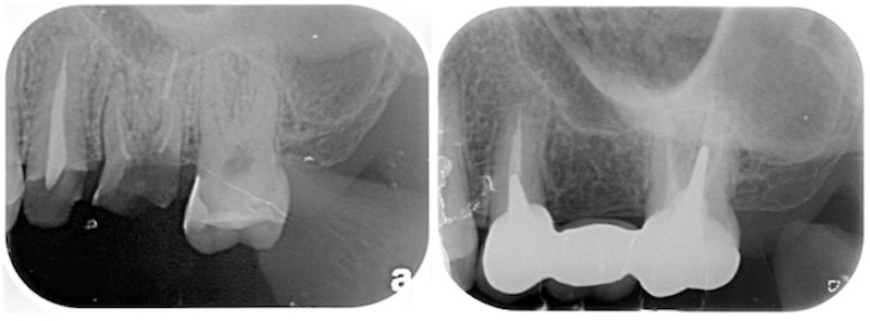 牙周病治療程序-拔牙-缺牙-牙橋-X光片