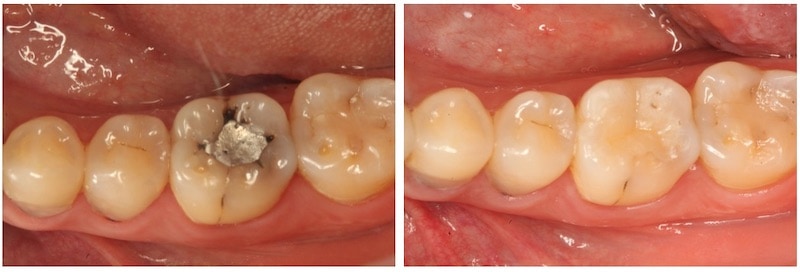 銀粉補牙-二次蛀牙-牙周病治療程序-3D齒雕-修復蛀牙