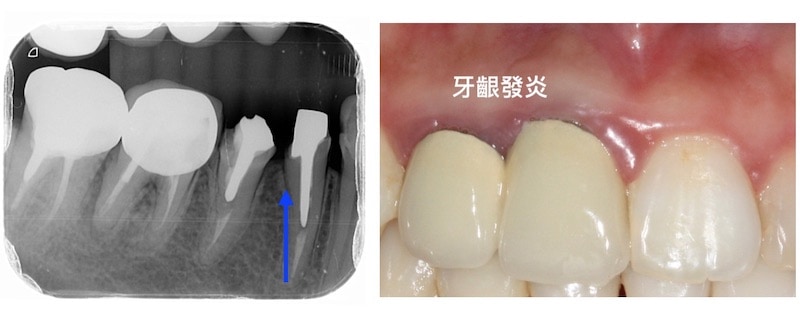 牙周病治療經驗-牙套-齒槽骨-牙冠增長術-生物寬度-牙套牙根接合過深-牙齦發炎-桃園牙周病
