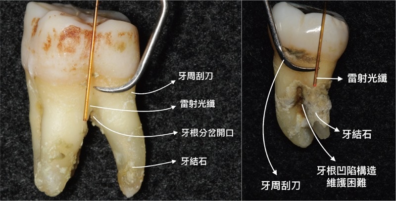 牙周病治療經驗-牙結石-牙周囊袋-雷射-牙周刮刀-深度