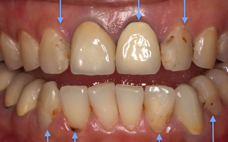牙周病治療前-牙齒狀況-牙根外露-牙齦發炎-蛀牙