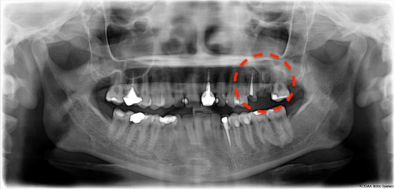 輕微牙周病-蛀牙-牙周病治療前X光片