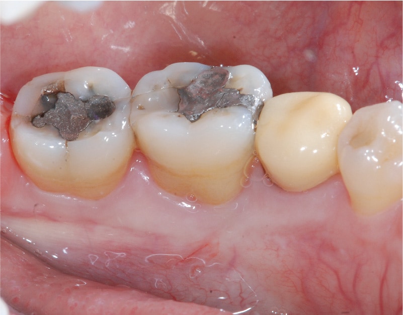 牙周病第一階段治療後-臼齒