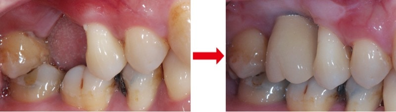 牙周翻瓣手術-植牙缺牙-十年全口牙周追蹤-葉立維醫師-桃園牙周病