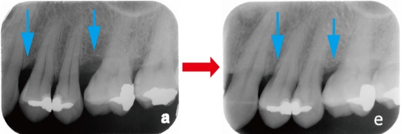 牙周翻瓣手術-牙周囊袋-齒槽骨自然再生-葉立維醫師-桃園牙周病