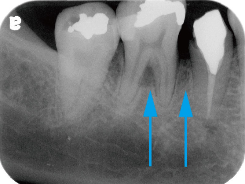 牙周翻瓣手術-牙周囊袋手術-牙周再生手術-術後X光片