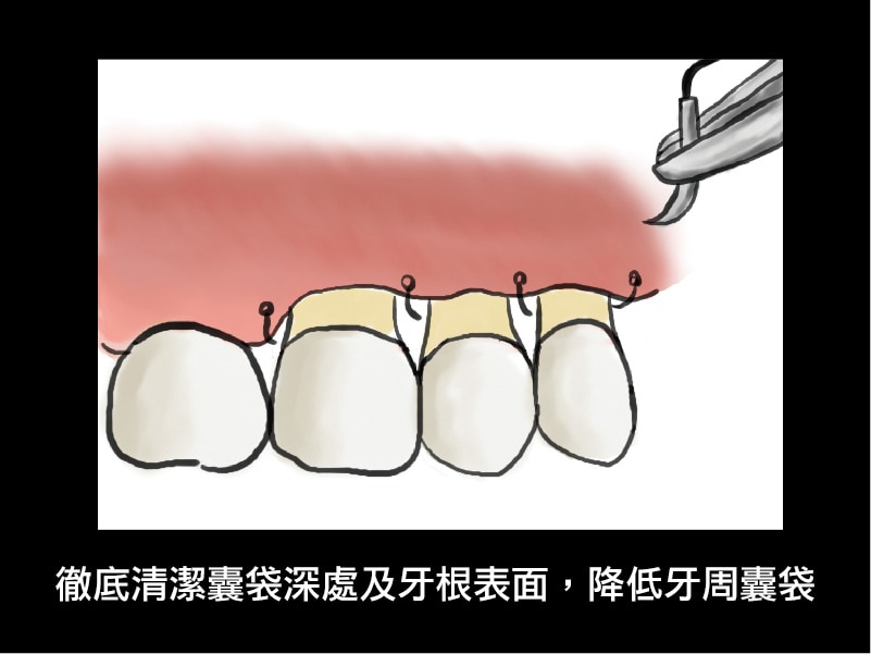 牙周翻瓣手術-牙周囊袋手術-術後-牙周囊袋恢復-葉立維醫師-桃園牙周病