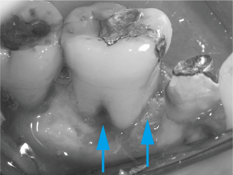 牙周翻瓣手術-牙周囊袋手術-補骨