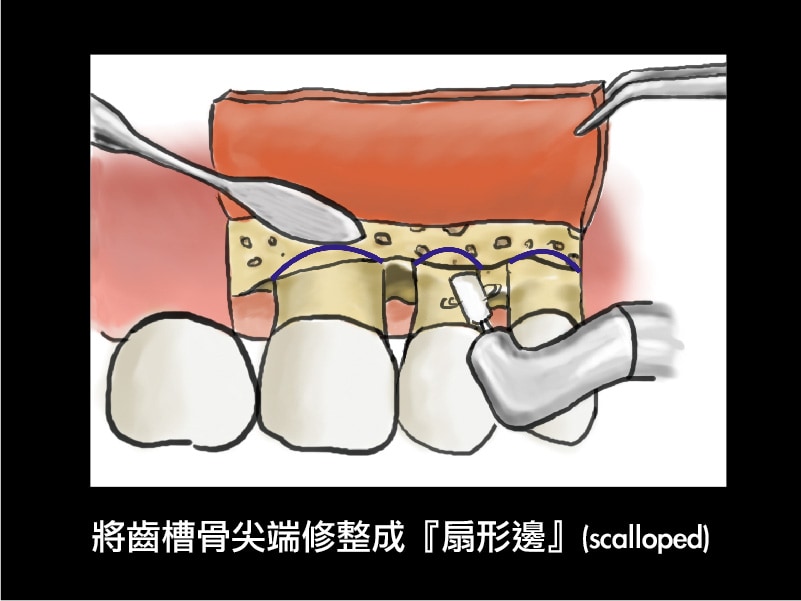 牙周翻瓣手術-牙周囊袋深度-修整齒槽骨-扇形邊-葉立維醫師-桃園牙周病
