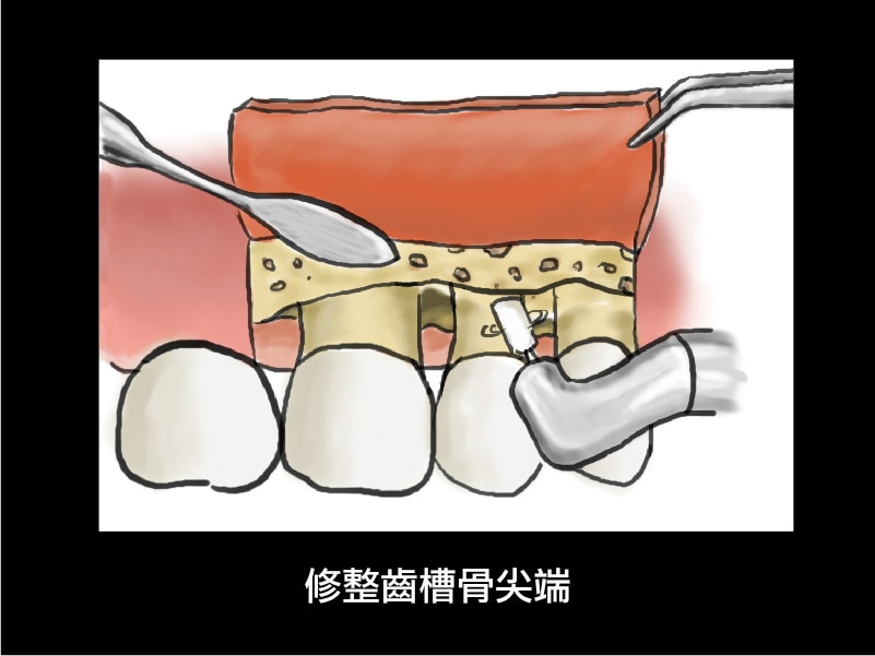 牙周翻瓣手術-牙周囊袋深度-修整齒槽骨-葉立維醫師-桃園牙周病