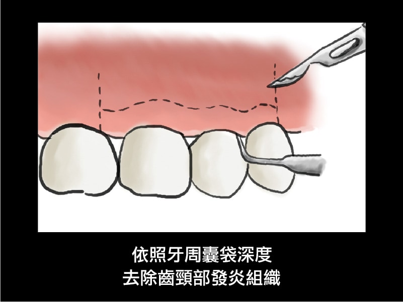 牙周翻瓣手術-牙周囊袋深度-去除發炎組織-葉立維醫師-桃園牙周病