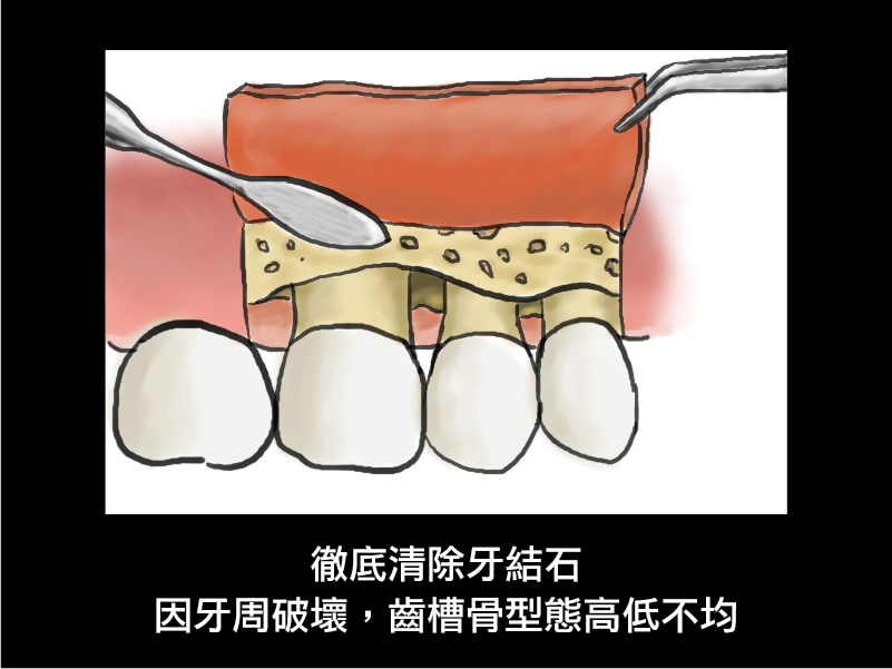 牙周翻瓣手術-牙周囊袋深度-清除牙結石-齒槽骨高低不均-葉立維醫師-桃園牙周病