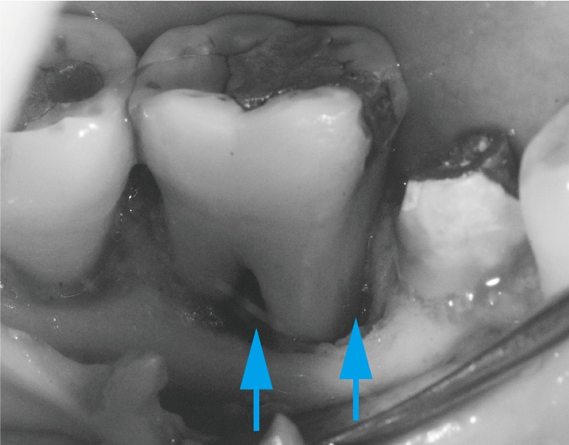牙周翻瓣手術-術後-牙根分岔區-齒槽骨缺損處