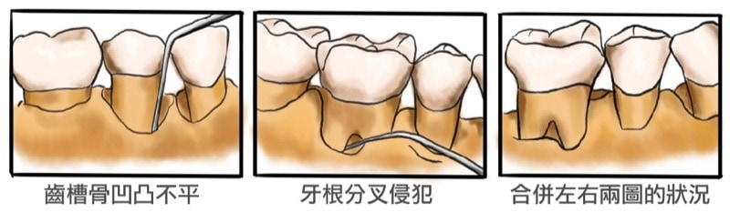 齒槽骨凹凸不平-牙根分叉侵犯-牙周手術治療-葉立維醫師-牙周病-桃園