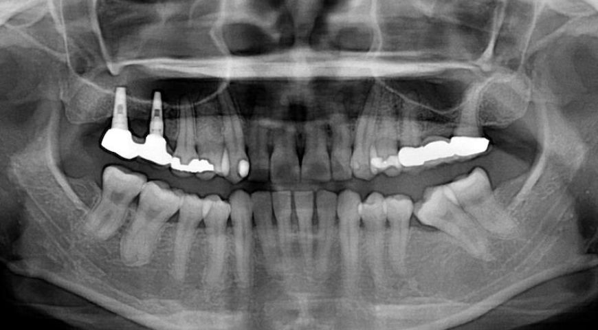 中度牙周病治療推薦: 全口牙周病/牙冠增長術/鼻竇增高術