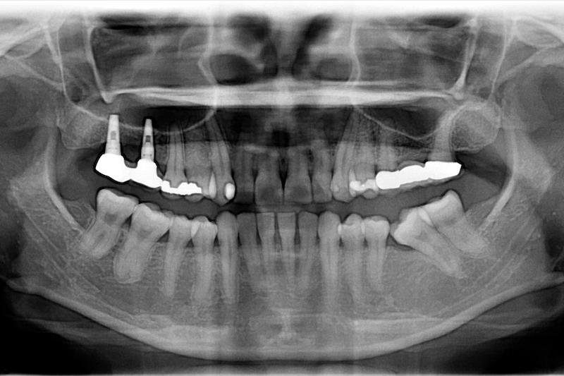 中度牙周病治療推薦: 全口牙周病/牙冠增長術/鼻竇增高術
