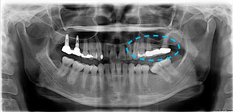 中度牙周病-環口式X光片-左上假牙不密合-左下缺牙不補