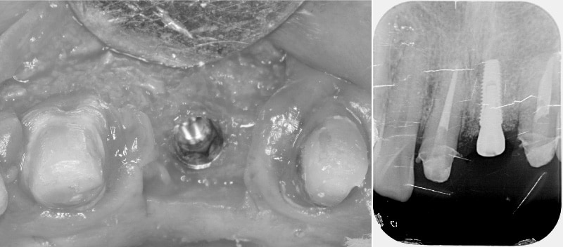 人工植牙-舒眠牙醫-人工牙根-X光片