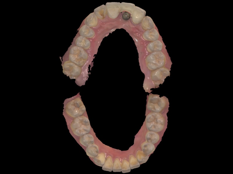 假牙製作前-數位牙科-上下顎-口腔掃描