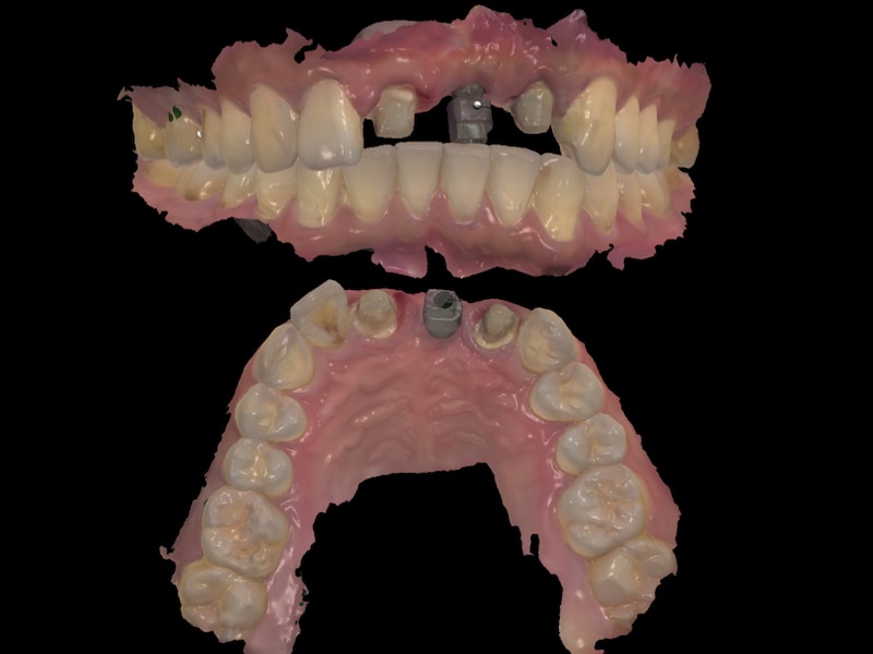 假牙製作前-數位牙科-牙齒咬合-口腔掃描