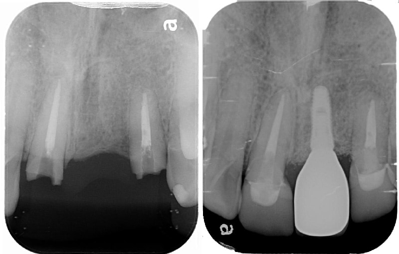 全口輕度牙周病-局部嚴重牙周病-植牙-全瓷牙冠-治療前後-X光片