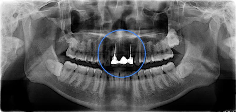 全口輕度牙周病-局部嚴重牙周病-治療前-假牙拆除前-環口式X光片