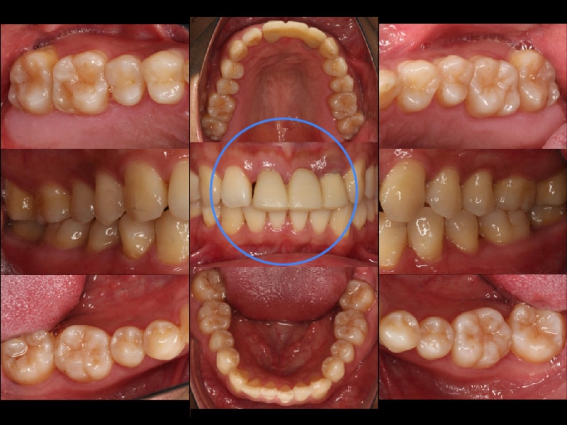 全口輕度牙周病-局部嚴重牙周病-治療前-前牙-臨時假牙