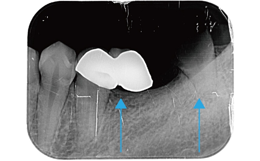 左下後牙區-假牙-臼齒殘根-X光片